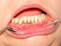 Пигментированные твердые зубные отложения (зубной камень) фото