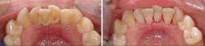Удаление зубных отложений до и после
