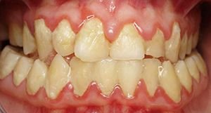 Массивные скопления мягкого зубного налета в области всех зубов фото