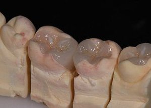 Керамические вкладки на гипсовой модели зубов