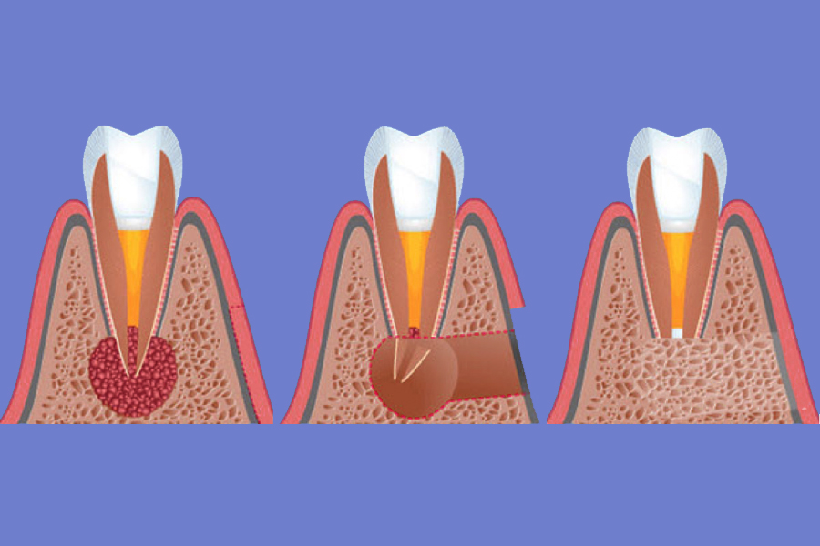 Температура после лечения зуба. Операция цистэктомия с резекцией верхушки корня. Цистэктомия и цистотомия зуба. Периодонтальный абсцесс зуба. Резекция верхушки корня гранулема.