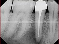 В области верхушки корня нижнего зуба периодонтальный абсцесс