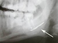 Введение пломбировочной пасты в нижне-челюстной канал