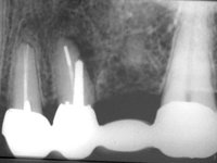 Перфорация корня зуба, допущенная при установке штифта фото