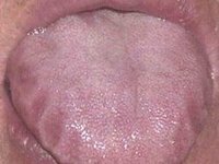 Следы зубов на боковой поверхности языка при бруксизме
