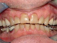 Вариант съемного протеза, который: защищает зубы от стирания, плюс восполняет высоту прикуса в жевательных отделах