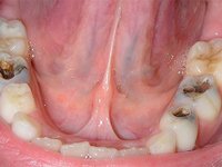 Кариес 3-х нижних зубов