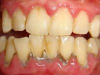 Зубной камень в области шеек нижних зубов фото