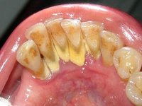 Твердые зубные отложения на внутренней поверхности нижних зубов фото