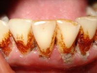 Обилие пигментного налета и зубных отложений фото