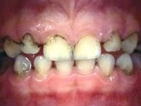 Черный налет на зубах у ребенка, следствие отложения солей железа фото