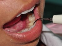Удаление зубных отложений ультразвуком фото