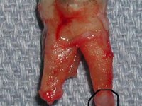 Гранулема прикрепленная к верхушке корня удаленного зуба фото
