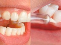 Процесс ирригации зубов