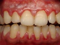 На фото скопления мягкого зубного налета у шеек зубов