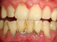 На фото скопления твердых зубных отложений