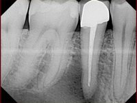 Периодонтальный абсцесс в области верхушки корня нижнего зуба