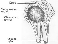 Схема кисты корня зуба