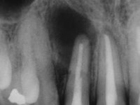 Исходная ситуация: киста корня зуба