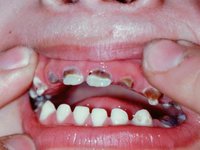 Множественное поражение молочных зубов кариесом