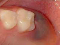 Гематома над прорезывающимся зубом фото