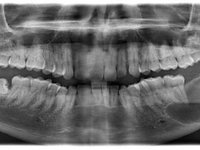 Ретромолярная киста зуба