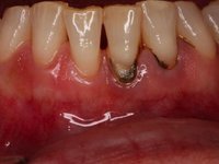 Твердые зубные отложения (зубной камень)