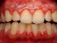 Скопления мягкого зубного налета в области шеек зубов фото
