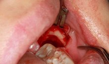 Вид лунки удаленного зуба и костной ткани челюсти сразу после извлечения зуба мудрости