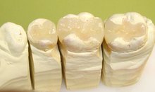 Готовые керамические вкладки из гипсовой модели зубов пациента