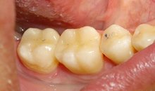 Керамические вкладки фиксированны на зубы