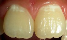 Демирализованные участки эмали в виде белых пятен у шеек зубов
