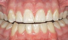 Многочисленные демирализованные участки эмали в виде белых пятен у шеек зубов
