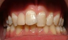 Демирализованные участки эмали в виде белых пятен у шеек зубов