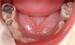 Глубокий кариес у ребенка на жевательных зубах фото