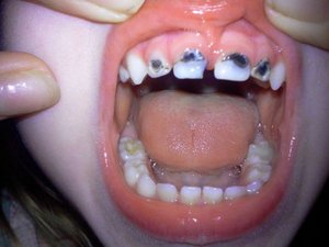 Фото зубов после серебрения