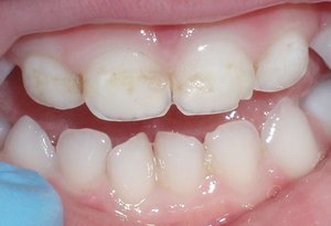 Фото зубов после полировки и глубокого фторирования