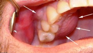 Припухлость десны с щечной стороны в проекции разрушенного зуба