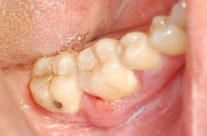 Пародонтальный карман в области щечной поверхности 6-го зуба