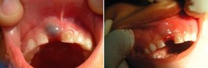 Вид кисты над прорезывающимся зубом до и после частичного иссечения стенки кисты