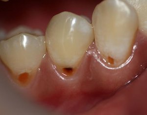 Клиновидный дефект зуба стадия