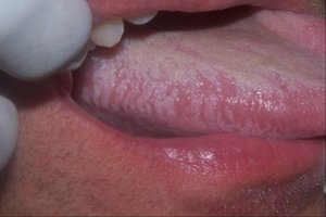 Разновидности лейкоплакии полости рта
