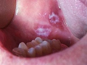 Разновидности лейкоплакии полости рта фото