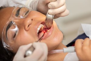 Профилактика осложнений после удаления зуба