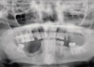 Диагностика остеомиелита челюсти