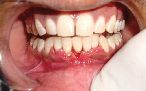 воспаление десны около зуба фото