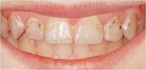 Кариес на передних зубах, лечение