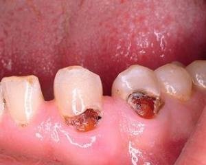 Пришеечный кариес зубов нижней челюсти фото