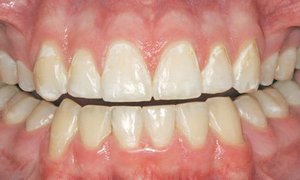 Кариес в стадии белого пятна на шейках верхних зубов фото