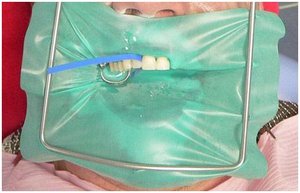 Изоляция зубов от слюны при помощи коффердама фото